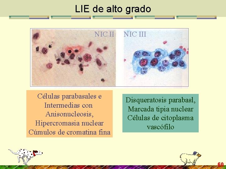 LIE de alto grado NIC II Células parabasales e Intermedias con Anisonucleosis, Hipercromasia nuclear