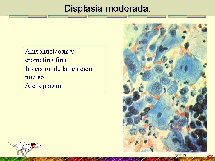 Displasia moderada. Anisonucleosis y cromatina fina Inversión de la relación nucleo A citoplasma 62