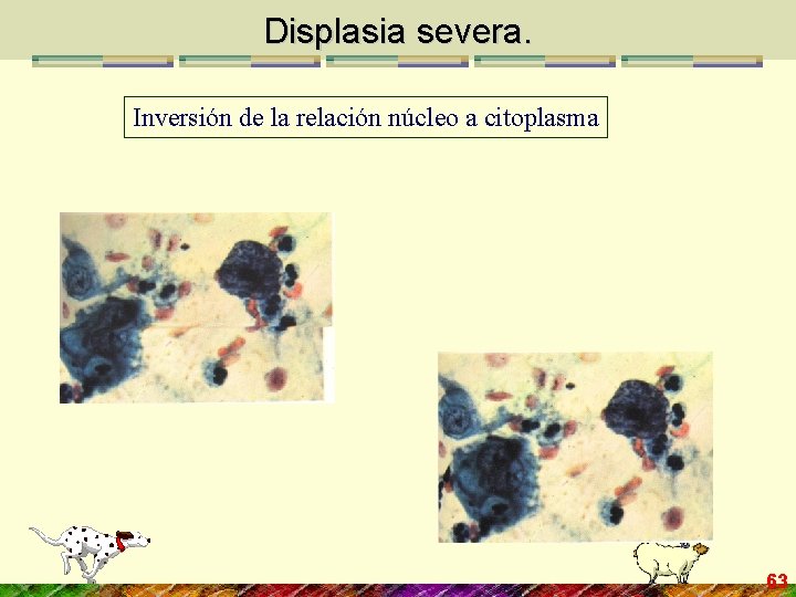 Displasia severa. Inversión de la relación núcleo a citoplasma 63 