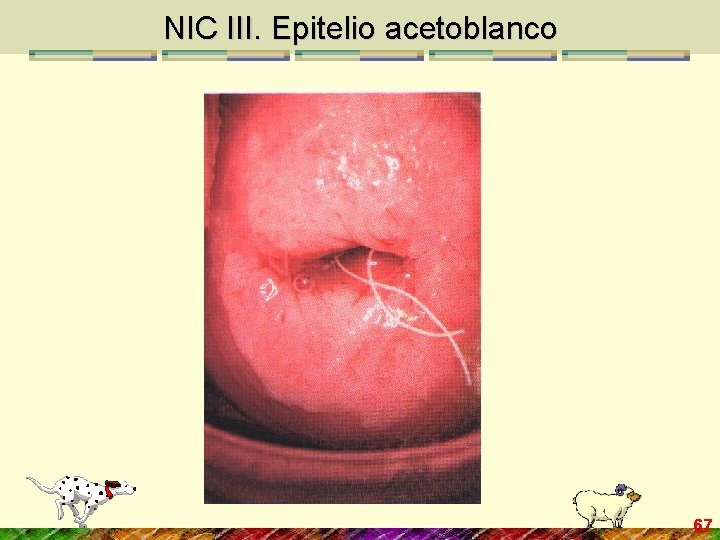 NIC III. Epitelio acetoblanco 67 