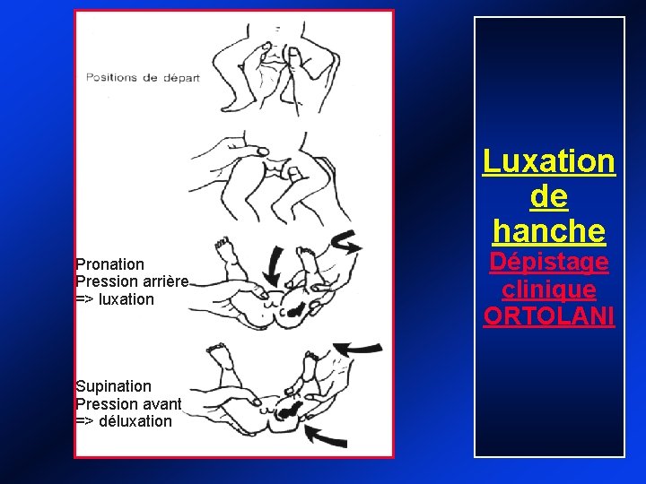 Luxation de hanche Pronation Pression arrière => luxation Supination Pression avant => déluxation Dépistage