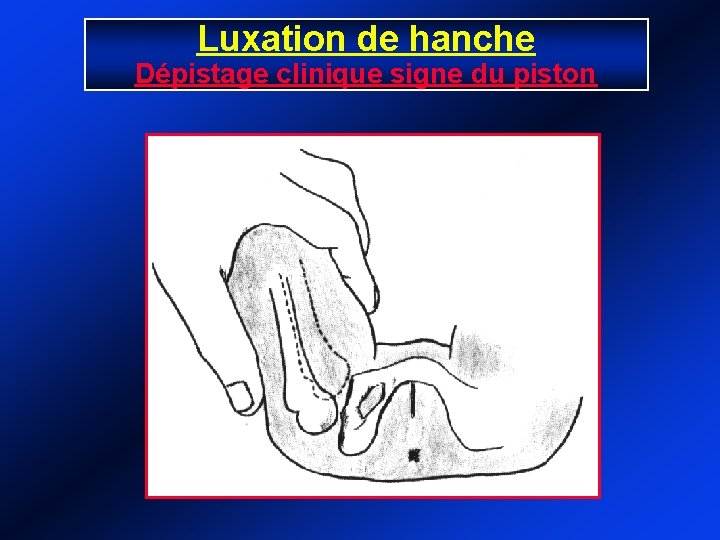 Luxation de hanche Dépistage clinique signe du piston 