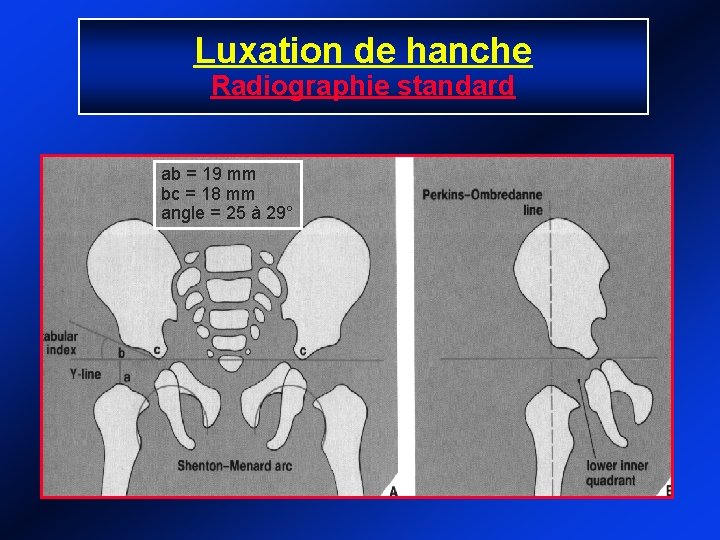 Luxation de hanche Radiographie standard ab = 19 mm bc = 18 mm angle