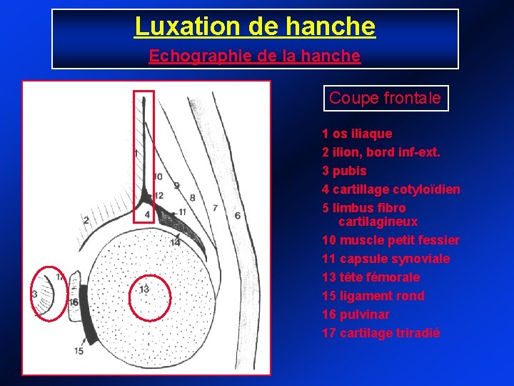 Luxation de hanche Echographie de la hanche Coupe frontale 1 os iliaque 2 ilion,