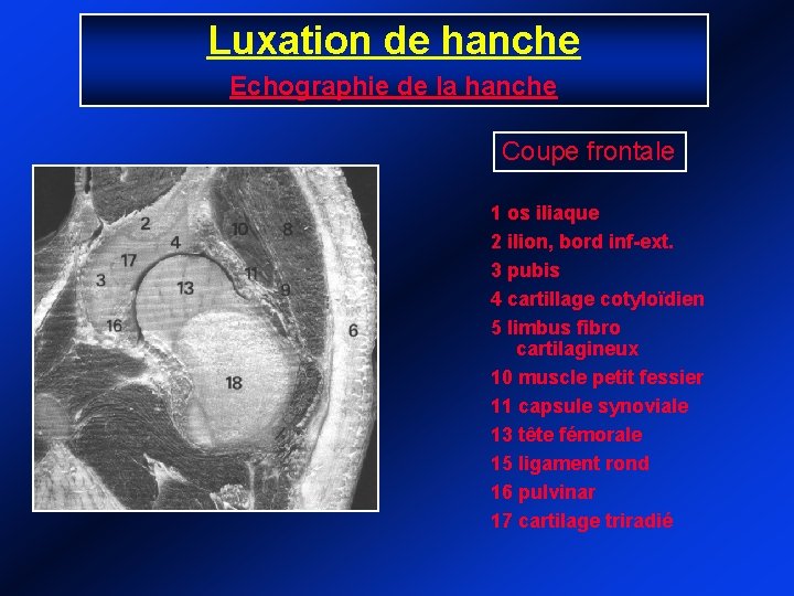 Luxation de hanche Echographie de la hanche Coupe frontale 1 os iliaque 2 ilion,