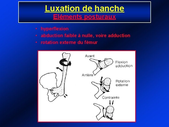 Luxation de hanche Eléments posturaux • hyperflexion • abduction faible à nulle, voire adduction