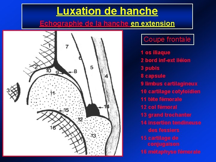 Luxation de hanche Echographie de la hanche en extension Coupe frontale 1 os iliaque