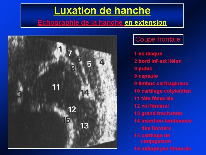 Luxation de hanche Echographie de la hanche en extension Coupe frontale 1 os iliaque