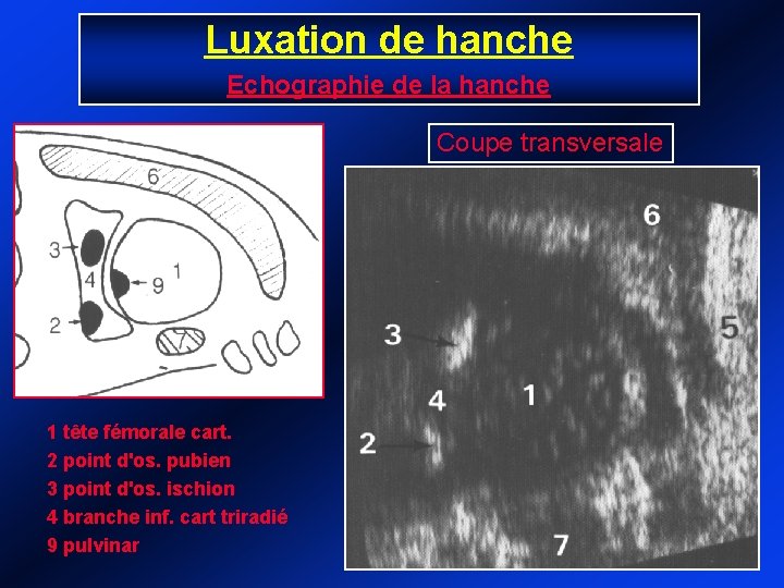 Luxation de hanche Echographie de la hanche Coupe transversale 1 tête fémorale cart. 2