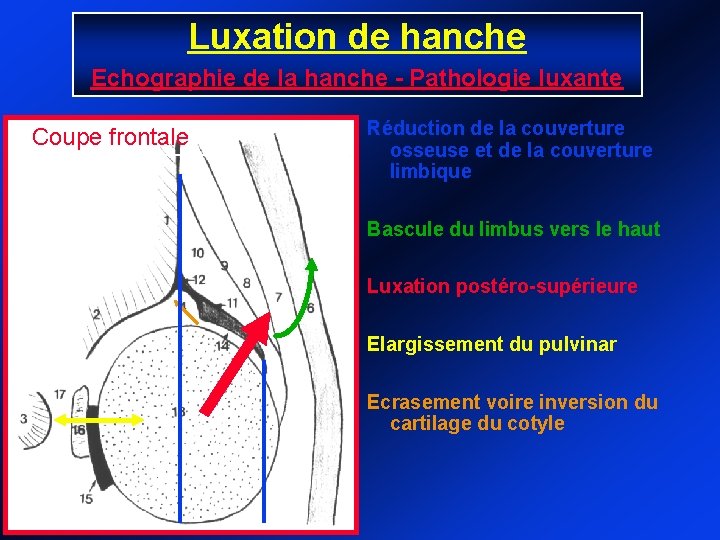 Luxation de hanche Echographie de la hanche - Pathologie luxante Coupe frontale Réduction de