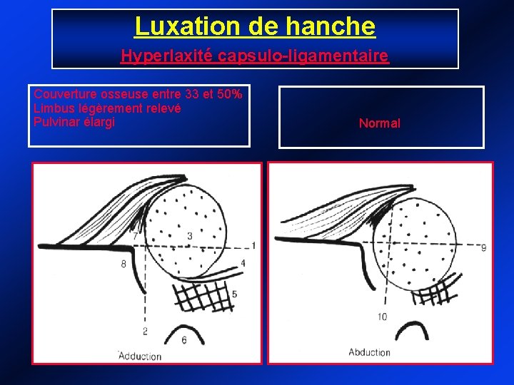 Luxation de hanche Hyperlaxité capsulo-ligamentaire Couverture osseuse entre 33 et 50% Limbus légèrement relevé