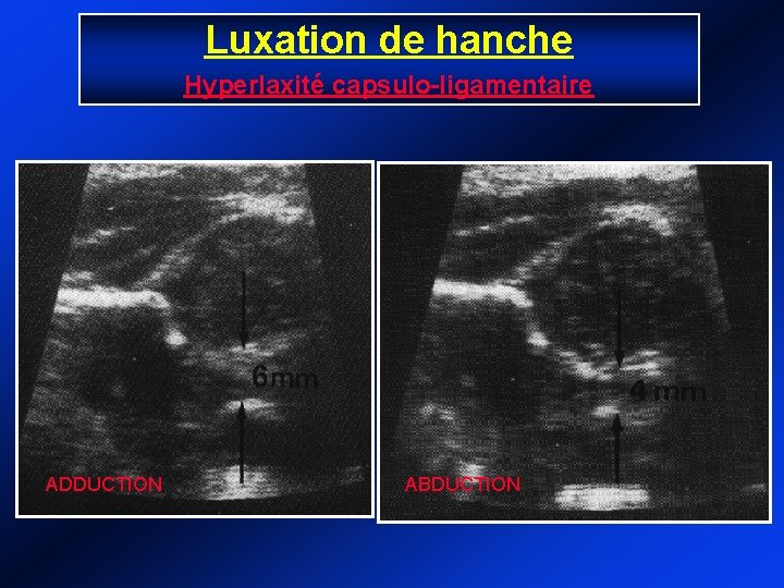 Luxation de hanche Hyperlaxité capsulo-ligamentaire ADDUCTION ABDUCTION 