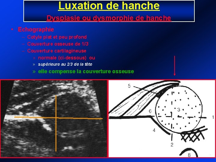 Luxation de hanche Dysplasie ou dysmorphie de hanche • Echographie – Cotyle plat et