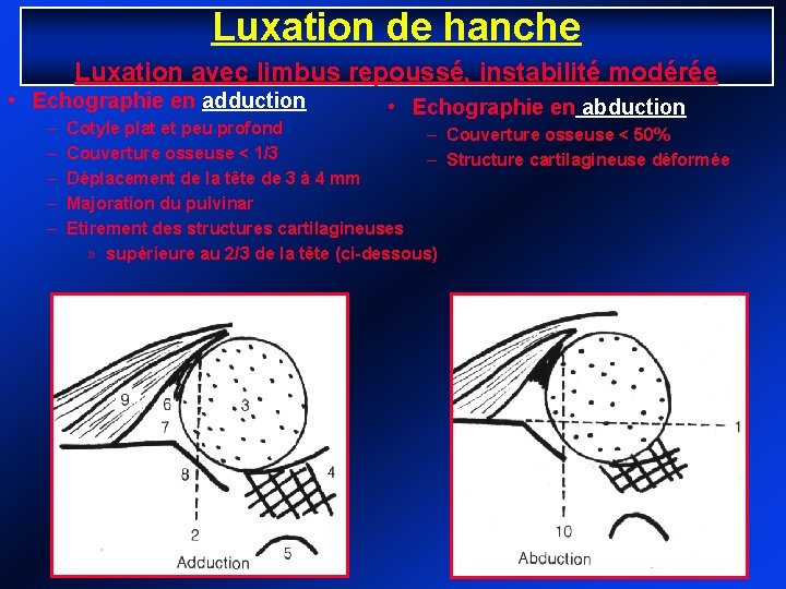 Luxation de hanche Luxation avec limbus repoussé, instabilité modérée • Echographie en adduction –