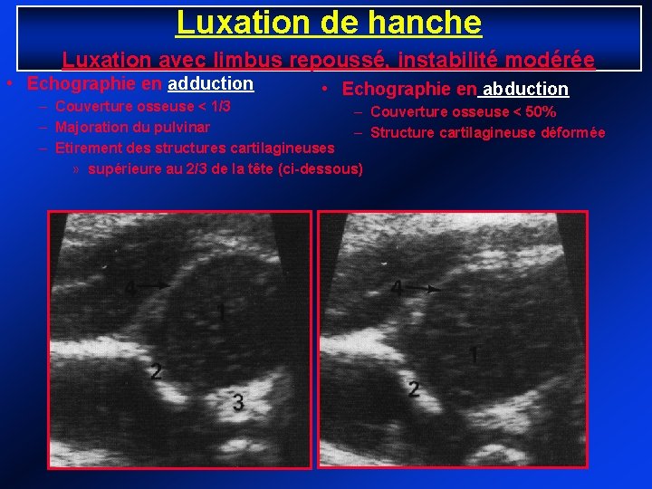 Luxation de hanche Luxation avec limbus repoussé, instabilité modérée • Echographie en adduction •