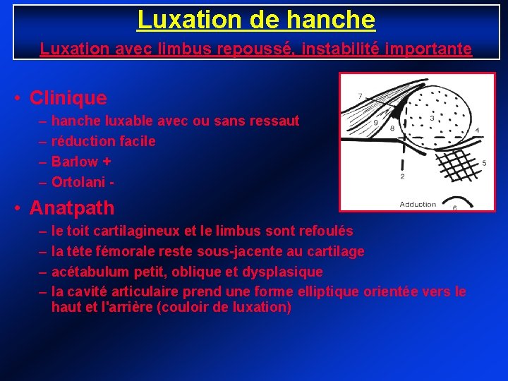 Luxation de hanche Luxation avec limbus repoussé, instabilité importante • Clinique – – hanche