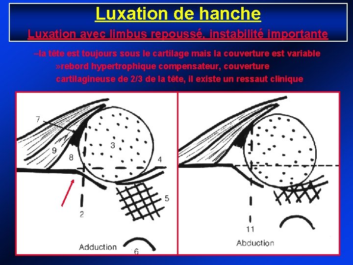 Luxation de hanche Luxation avec limbus repoussé, instabilité importante –la tête est toujours sous