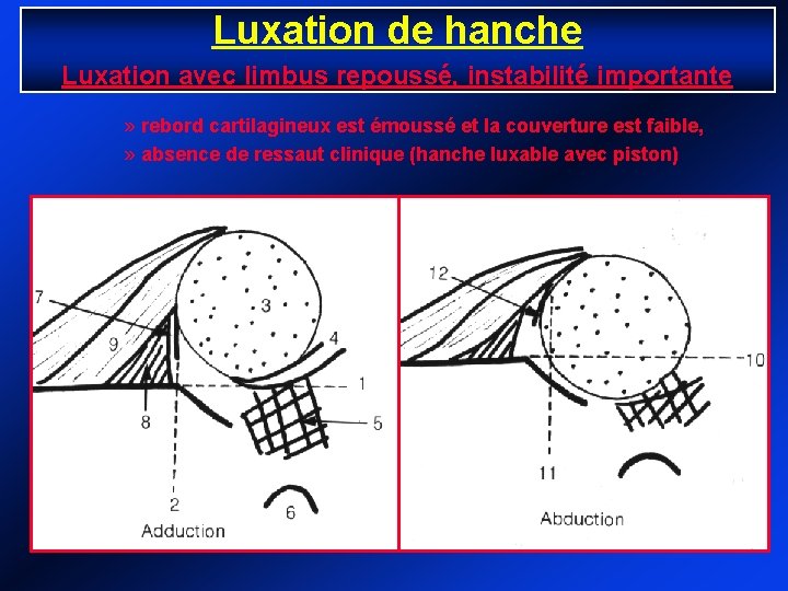 Luxation de hanche Luxation avec limbus repoussé, instabilité importante » rebord cartilagineux est émoussé