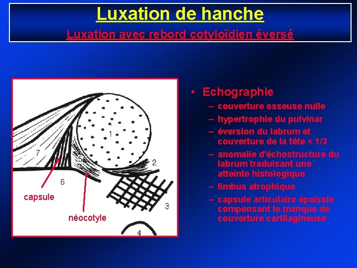 Luxation de hanche Luxation avec rebord cotyloïdien éversé • Echographie capsule néocotyle – couverture