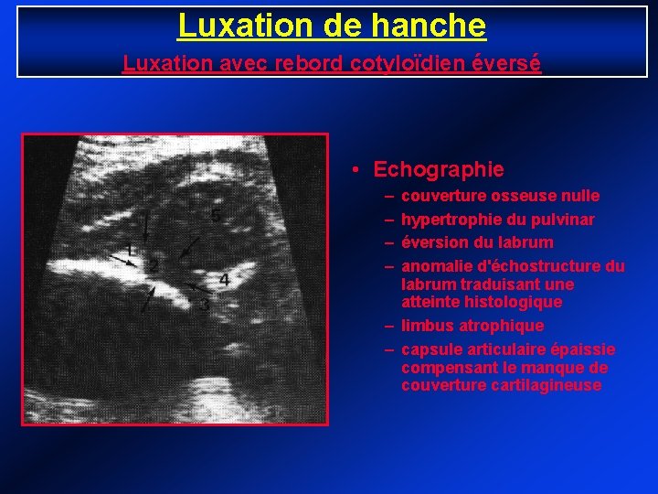 Luxation de hanche Luxation avec rebord cotyloïdien éversé • Echographie – – couverture osseuse