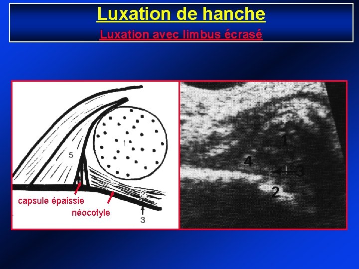 Luxation de hanche Luxation avec limbus écrasé capsule épaissie néocotyle 