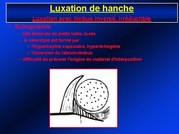 Luxation de hanche Luxation avec limbus inversé, irréductible • Echographie – tête fémorale de