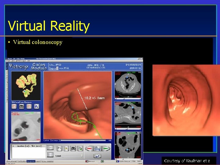 Virtual Reality • Virtual colonoscopy Courtesy of Kaufman et al. 