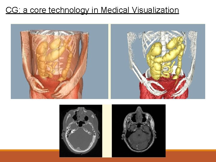 CG: a core technology in Medical Visualization 