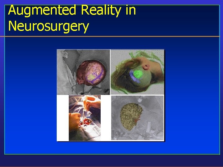 Augmented Reality in Neurosurgery 