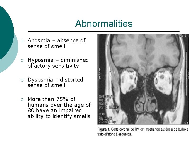 Abnormalities ¡ Anosmia – absence of sense of smell ¡ Hyposmia – diminished olfactory