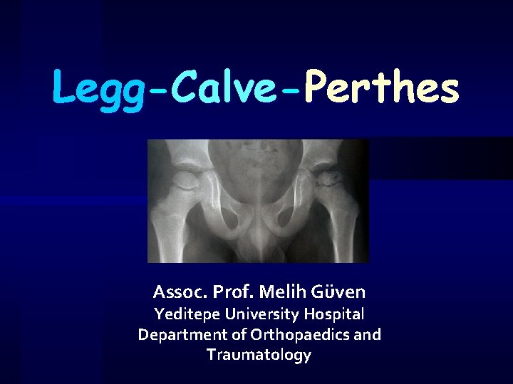 Legg-Calve-Perthes Assoc. Prof. Melih Güven Yeditepe University Hospital Department of Orthopaedics and Traumatology 