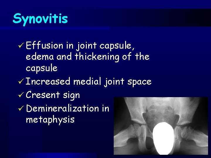 Synovitis ü Effusion in joint capsule, edema and thickening of the capsule ü Increased