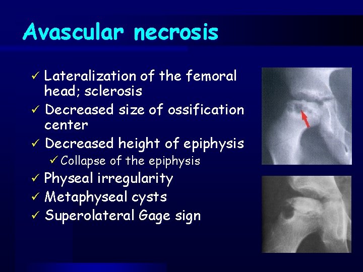 Avascular necrosis Lateralization of the femoral head; sclerosis ü Decreased size of ossification center