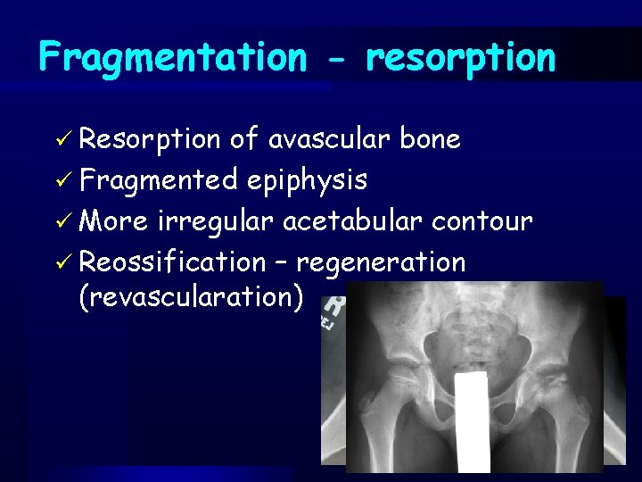 Fragmentation - resorption ü Resorption of avascular bone ü Fragmented epiphysis ü More irregular