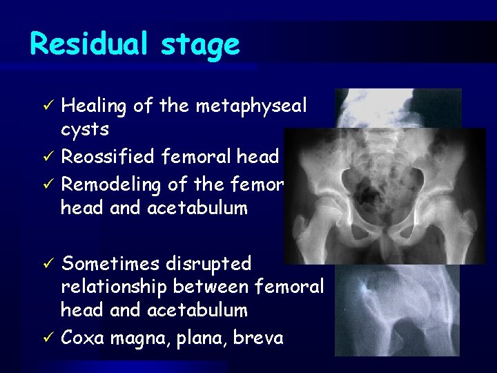 Residual stage Healing of the metaphyseal cysts ü Reossified femoral head ü Remodeling of