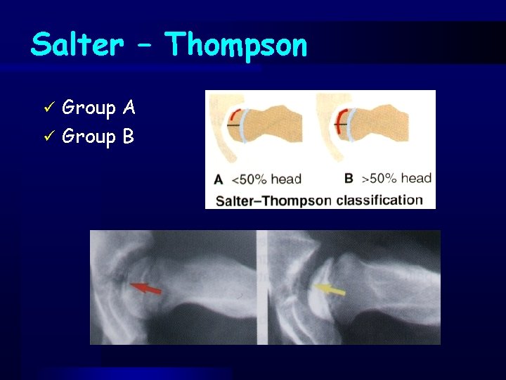 Salter – Thompson Group A ü Group B ü 