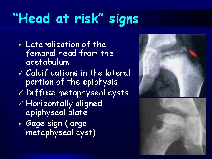 “Head at risk” signs Lateralization of the femoral head from the acetabulum ü Calcifications