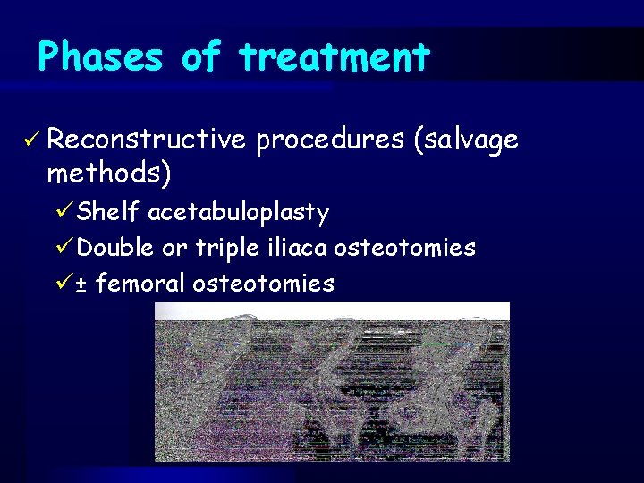 Phases of treatment ü Reconstructive methods) procedures (salvage üShelf acetabuloplasty üDouble or triple iliaca