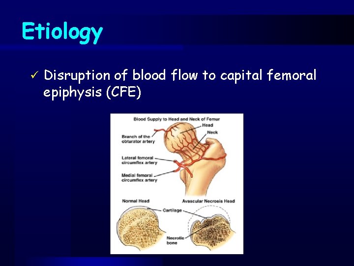 Etiology ü Disruption of blood flow to capital femoral epiphysis (CFE) 