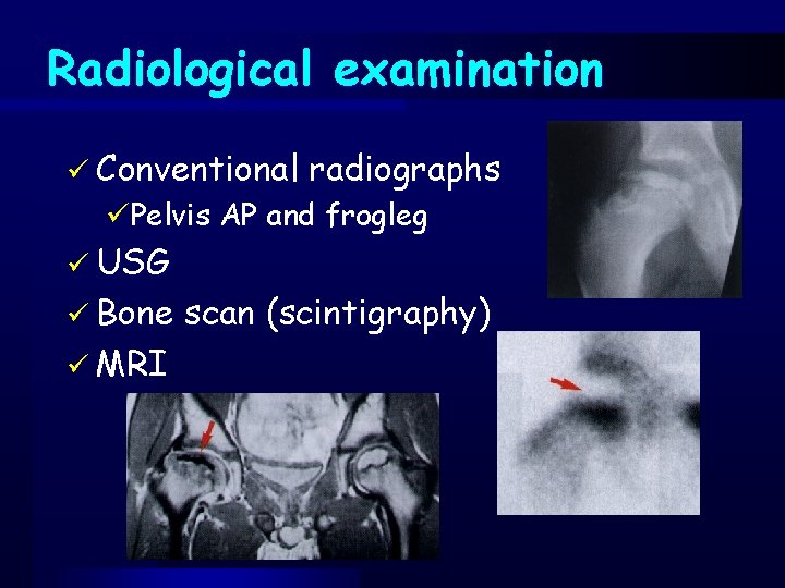 Radiological examination ü Conventional radiographs üPelvis AP and frogleg ü USG ü Bone ü