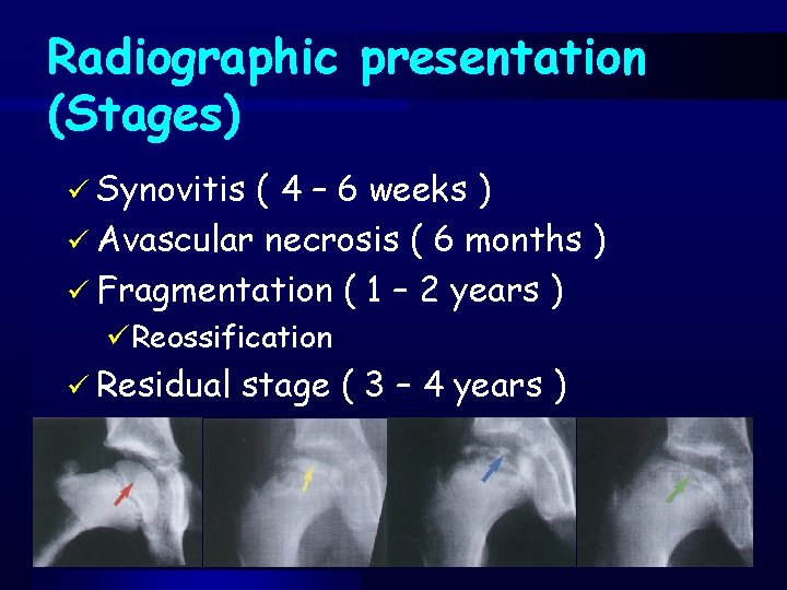 Radiographic presentation (Stages) ü Synovitis ( 4 – 6 weeks ) ü Avascular necrosis