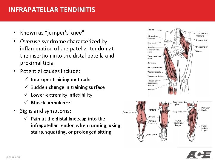 INFRAPATELLAR TENDINITIS • Known as “jumper’s knee” • Overuse syndrome characterized by inflammation of