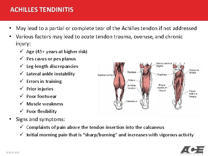 ACHILLES TENDINITIS • May lead to a partial or complete tear of the Achilles