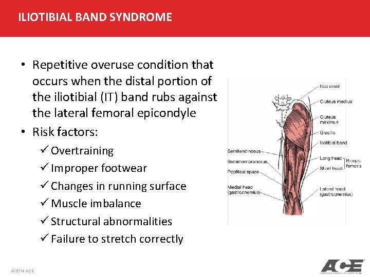 ILIOTIBIAL BAND SYNDROME • Repetitive overuse condition that occurs when the distal portion of