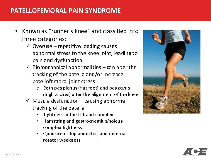 PATELLOFEMORAL PAIN SYNDROME • Known as “runner’s knee” and classified into three categories: ü