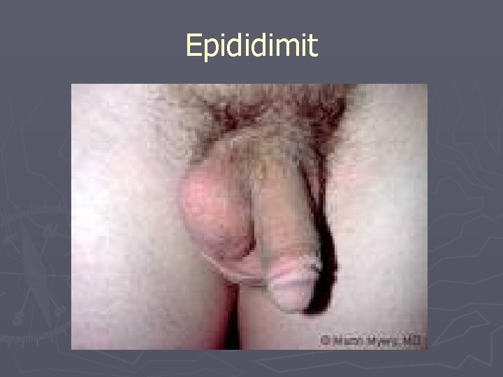 Epididimit 