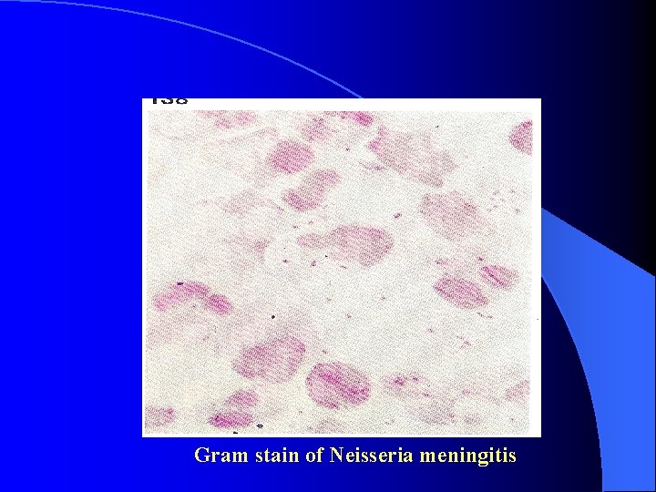 Gram stain of Neisseria meningitis 