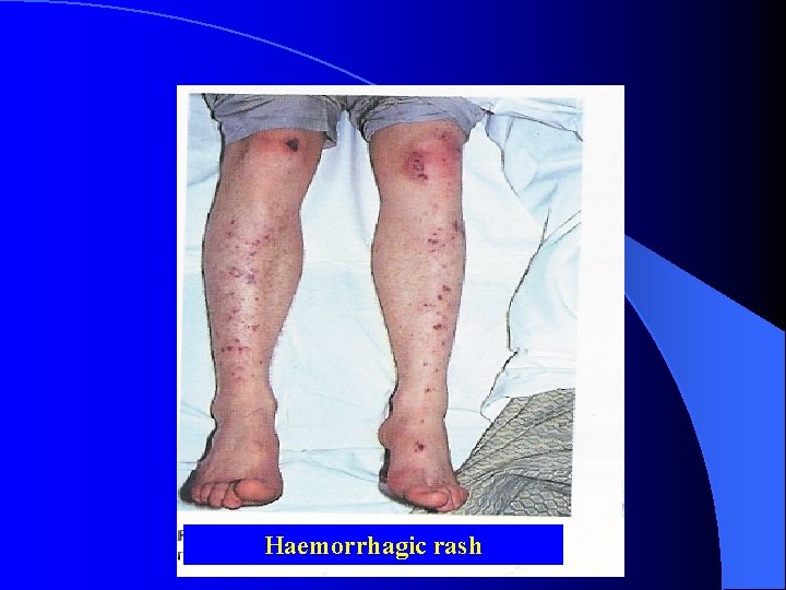 Haemorrhagic rash 