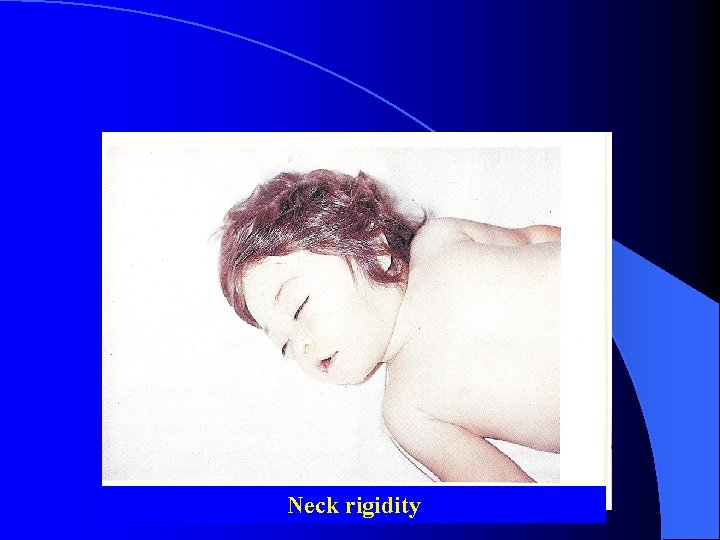 Neck rigidity 