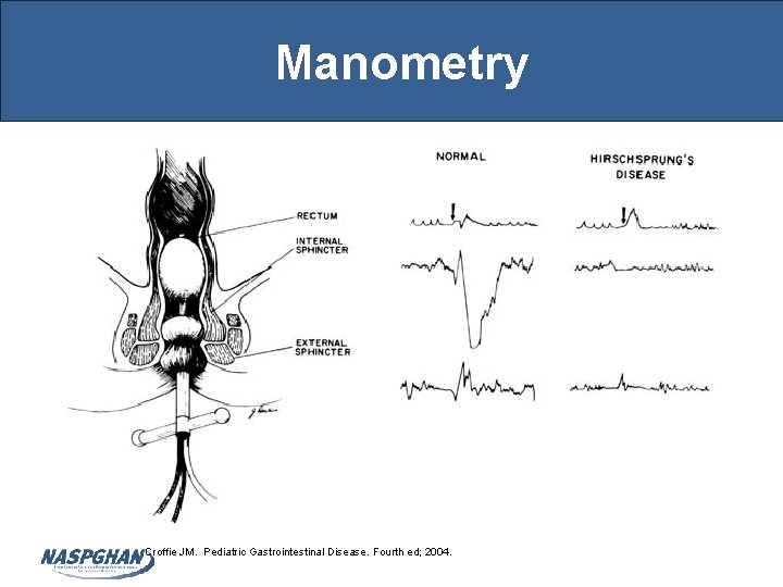 Manometry Croffie JM. Pediatric Gastrointestinal Disease. Fourth ed; 2004. 